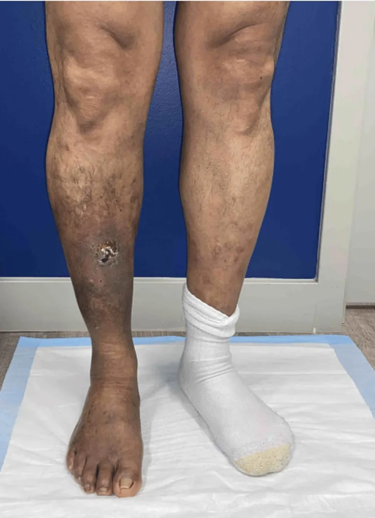 Piernas con una herida visible y un pie vendado