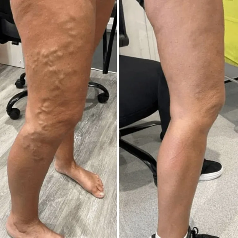 Comparación visual de piernas con distinta apariencia de las venas